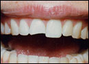 Image of teeth bonding before