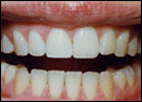 Image of teeth bonding after